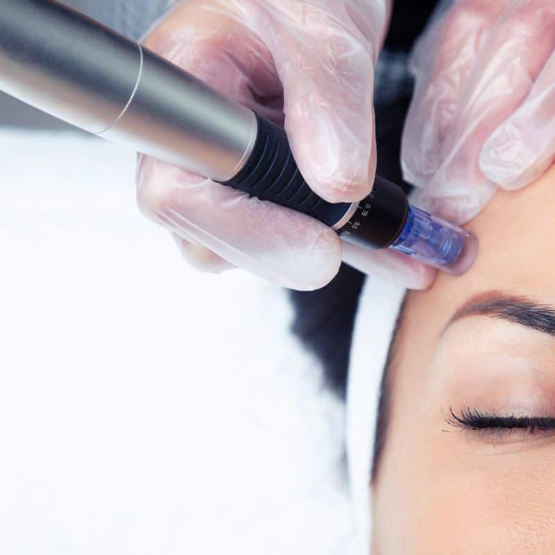 Morpheus8 treatment Sunbury from Lipo Sculpt - Book in today!